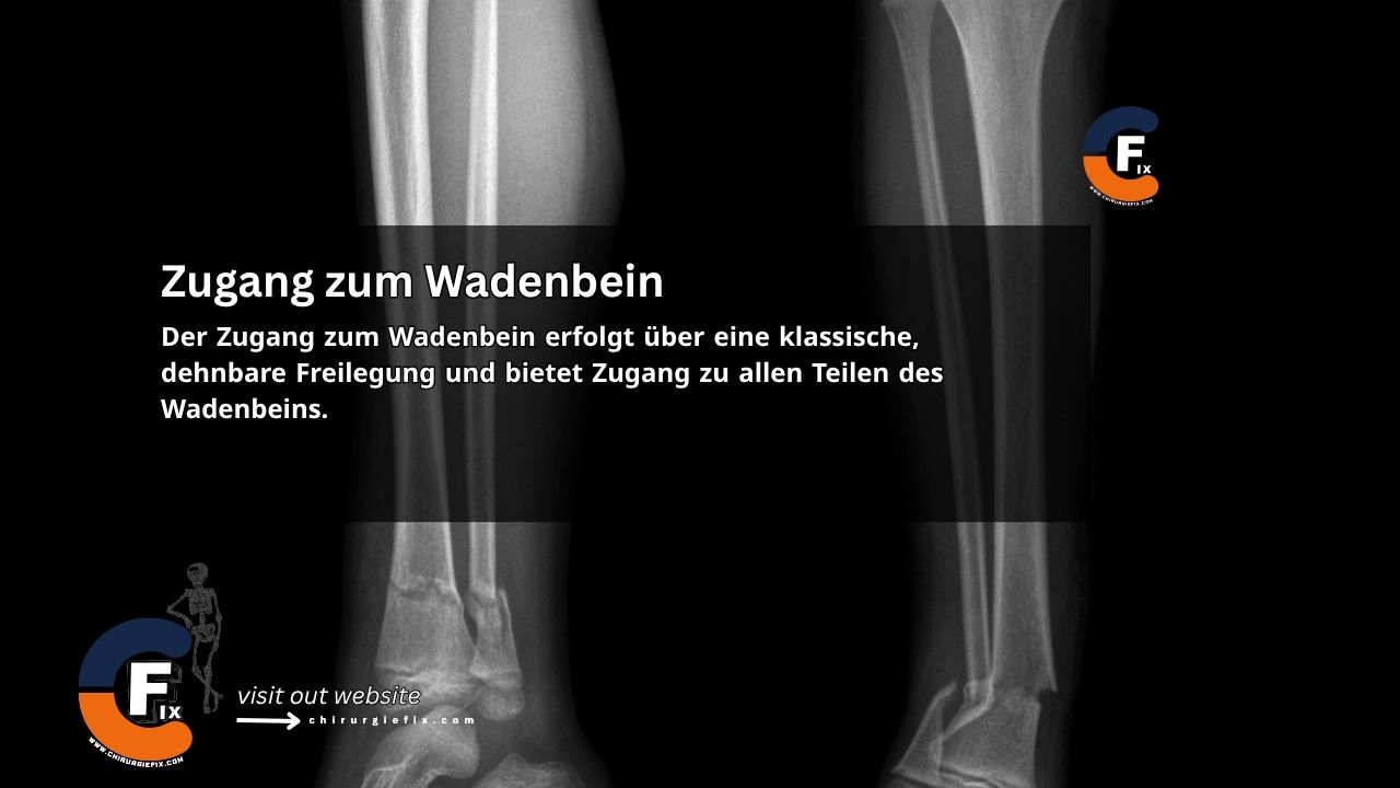 Approach to the Fibula