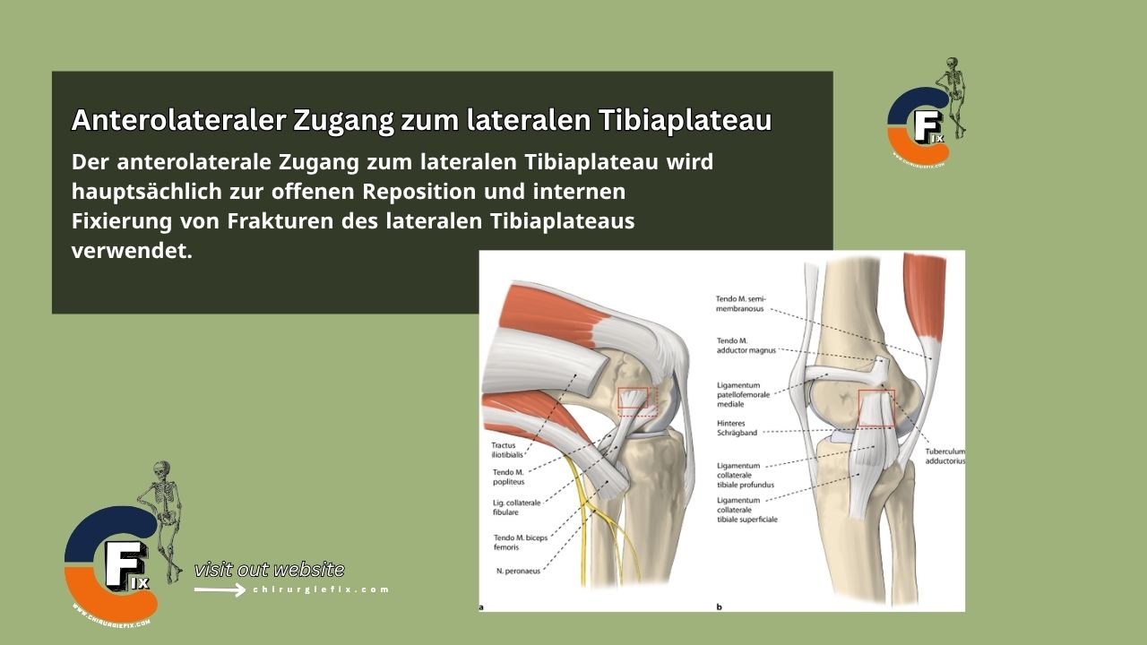Anterolateral Approach to Lateral Plateau