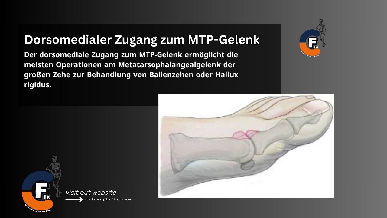 Dorsomedial Approach to MTP Joint