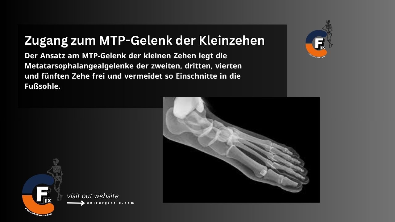 Lesser Toe MTP Joint Approach