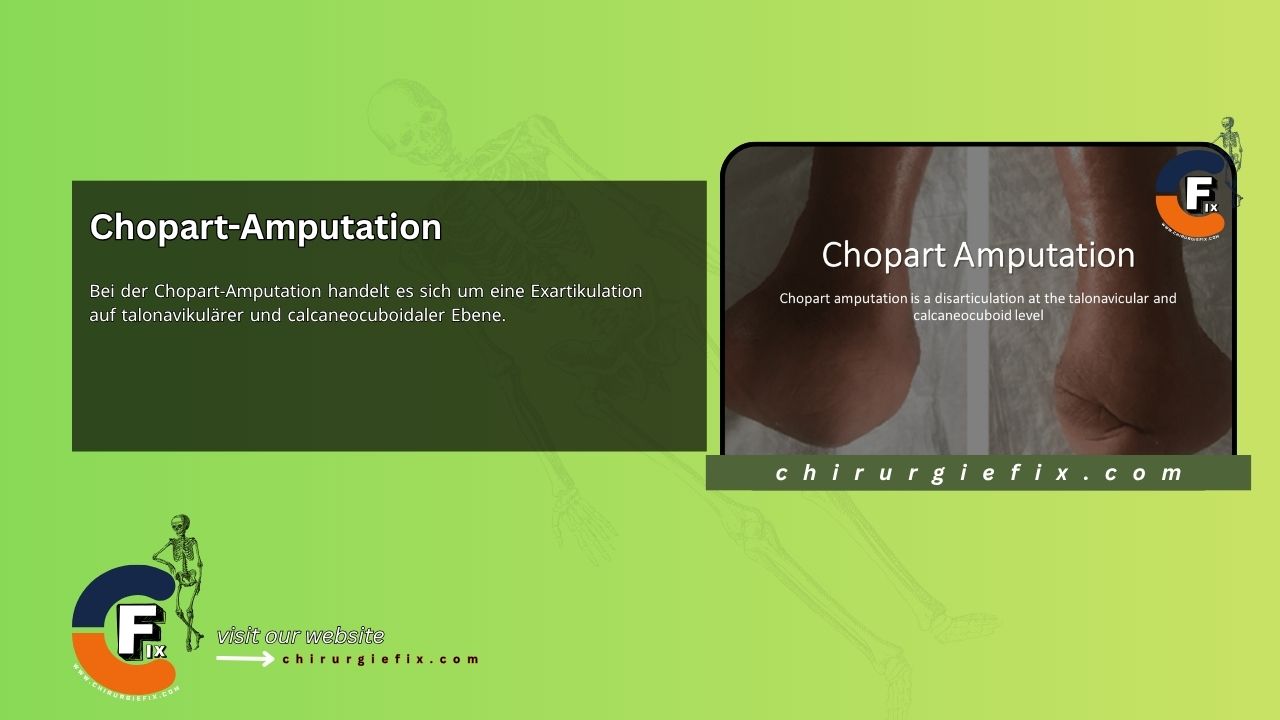Chopart Amputation
