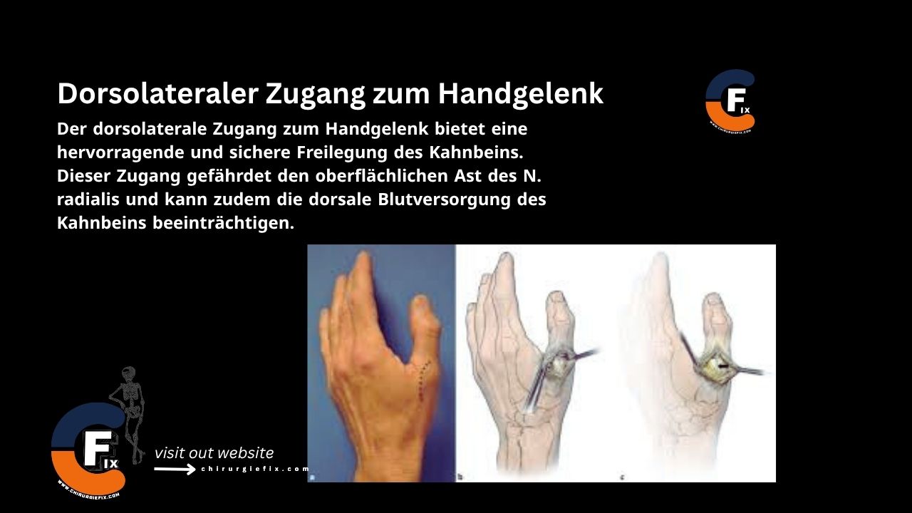 Dorsolateral approach to the Wrist