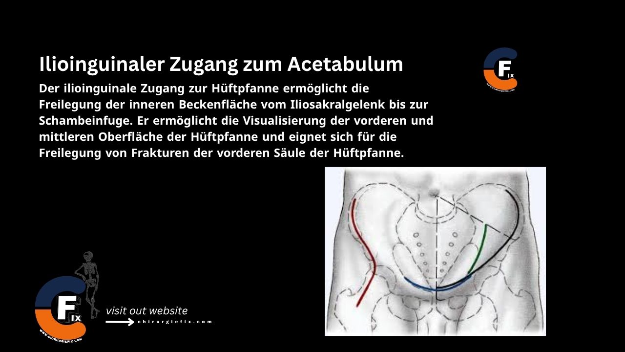 Ilioinguinal Approach to Acetabulum