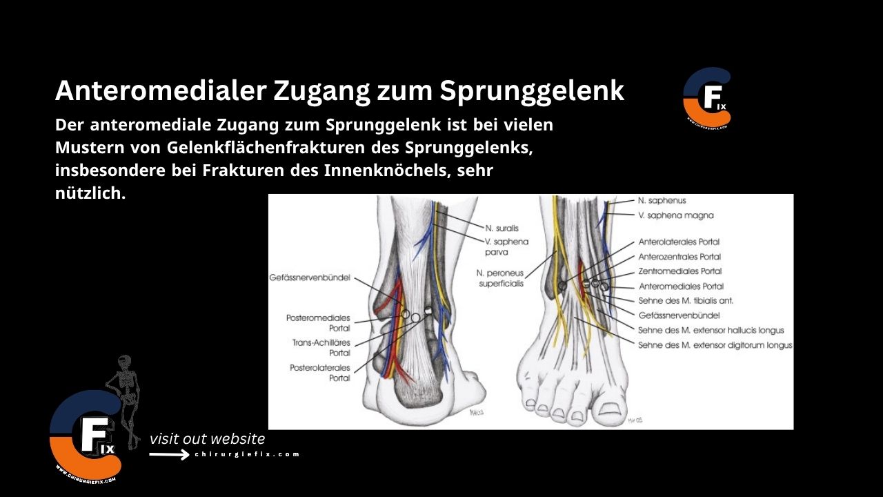 Anteromedial Approach to Ankle