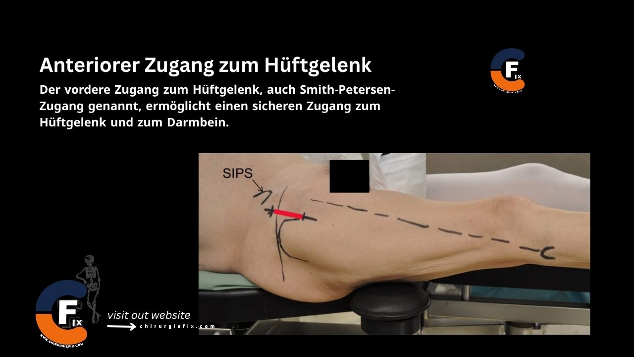 Anterior Approach to Hip