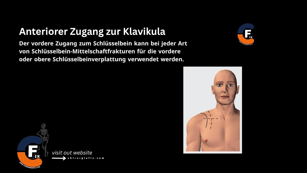 Anterior Approach to the Clavicle