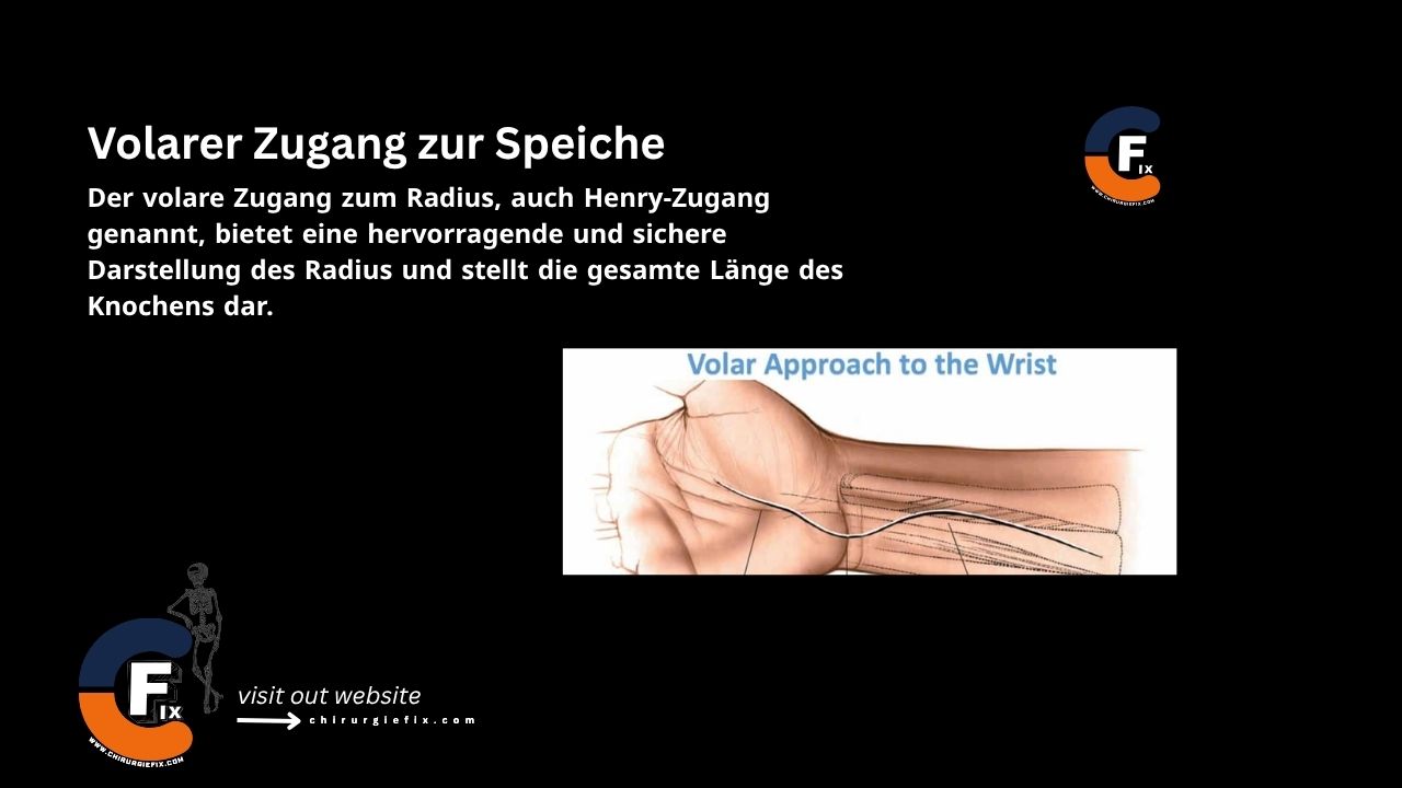 Volar Approach to Radius