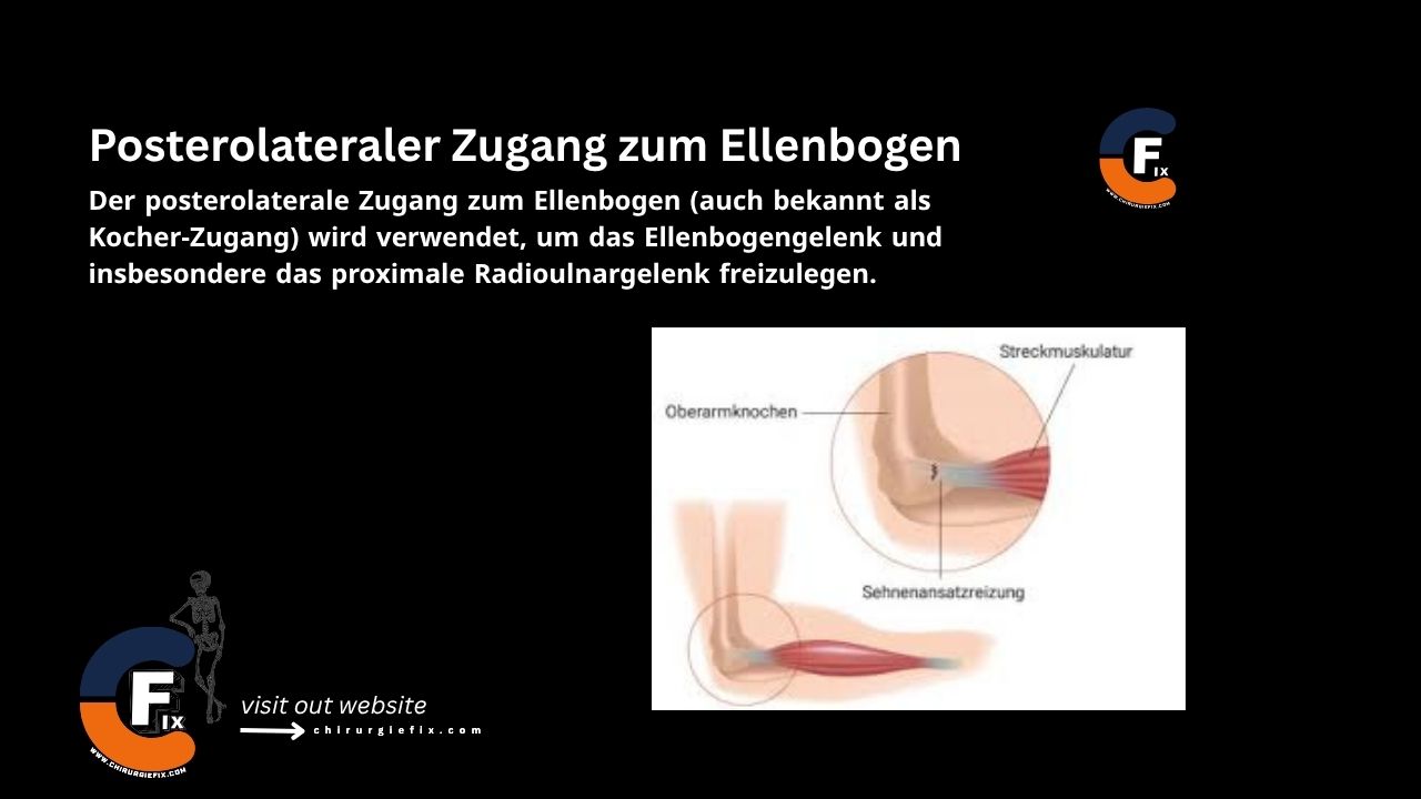 Posterolateral Approach to the Elbow