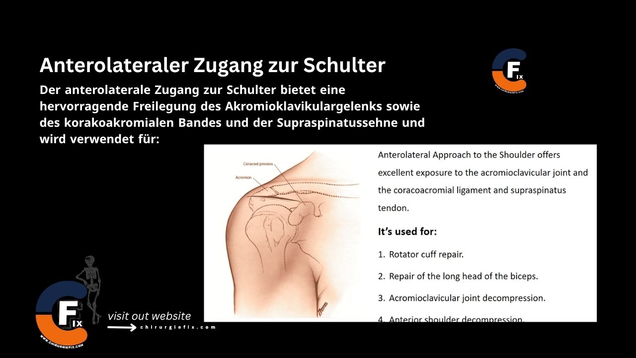 Anterolateral Approach to the Shoulder