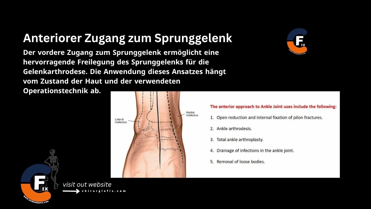 Anterior Approach to Ankle Joint