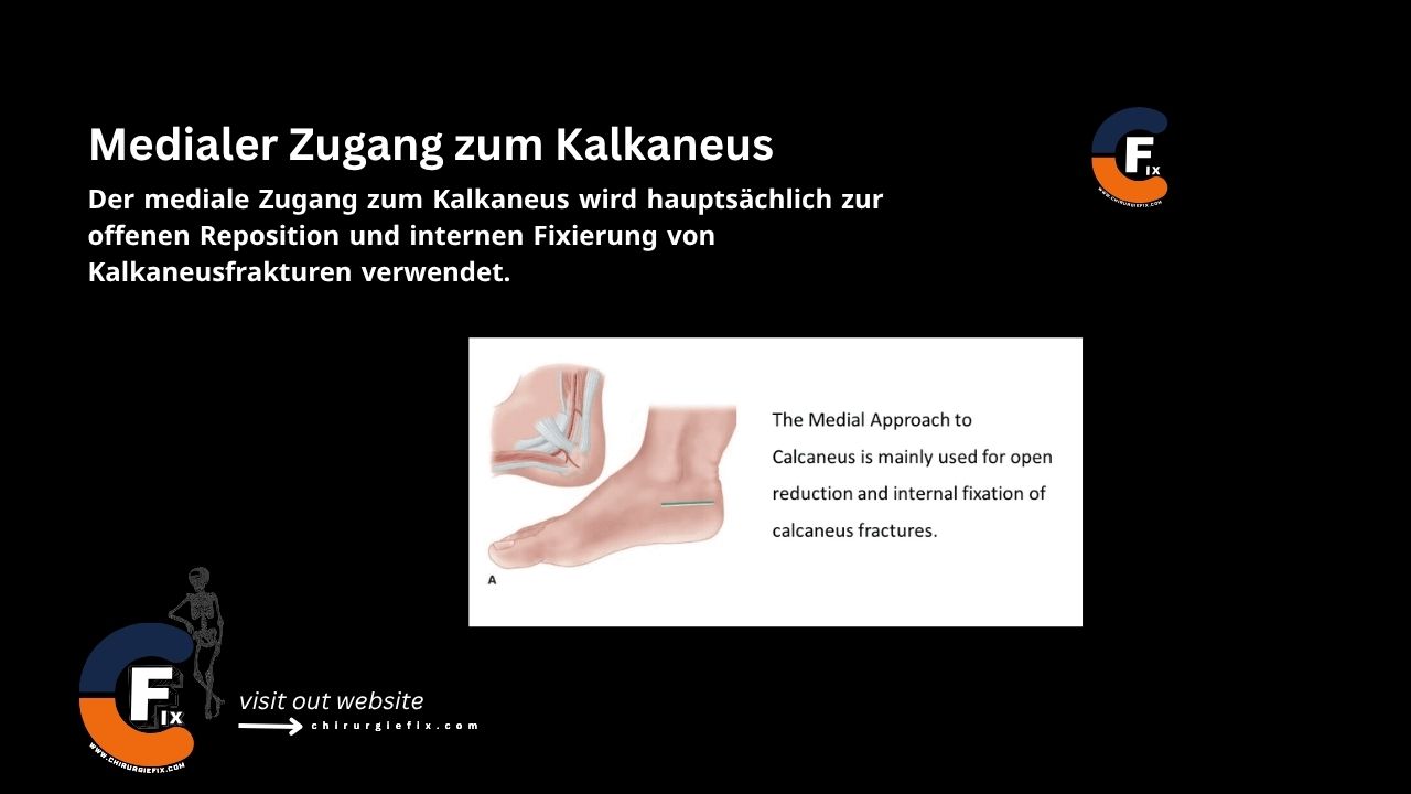 Medial Approach to Calcaneus