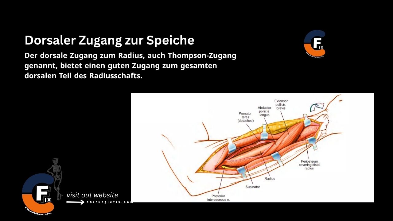 Dorsal approach to radius