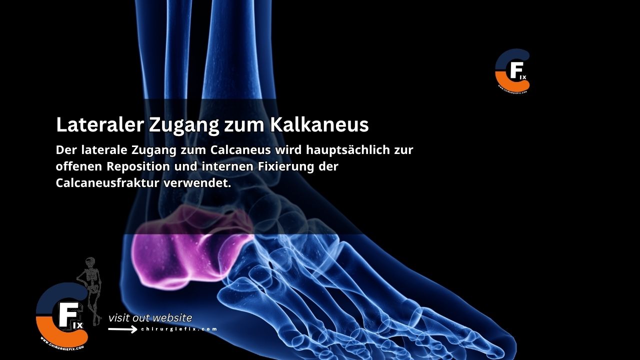 Lateral Approach to Calcaneus
