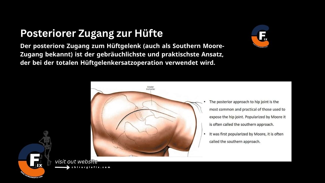 Posterior Approach to Hip
