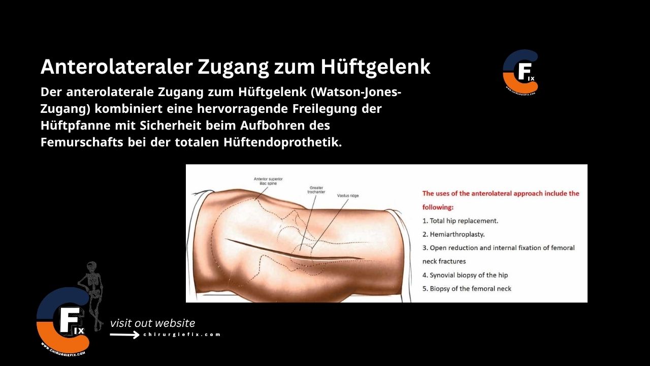 anterolateral approach to hip