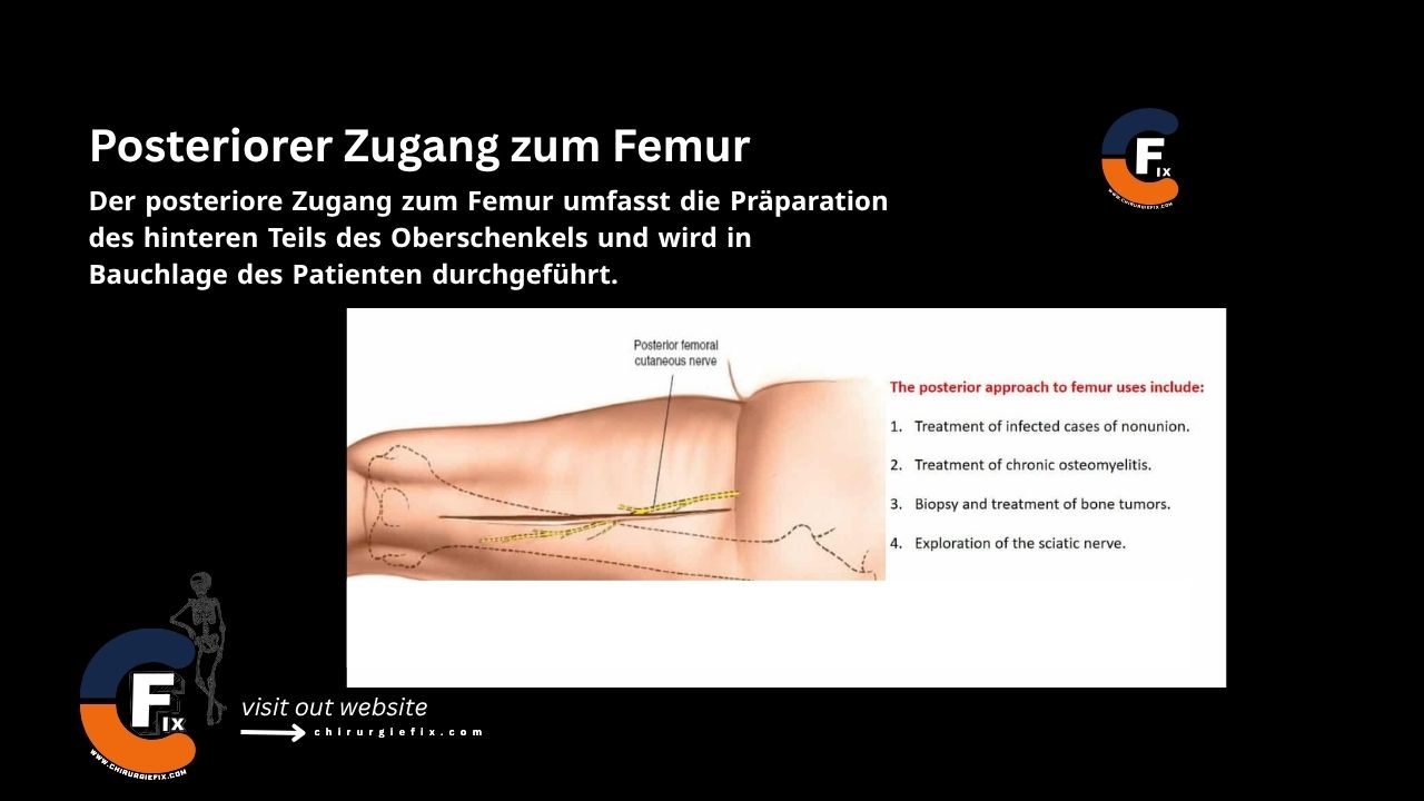 Posterior Approach to Femur