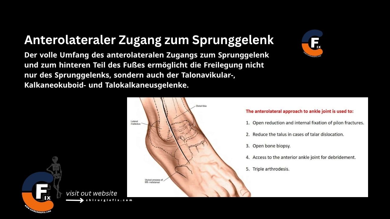 Anterolateral Approach to Ankle