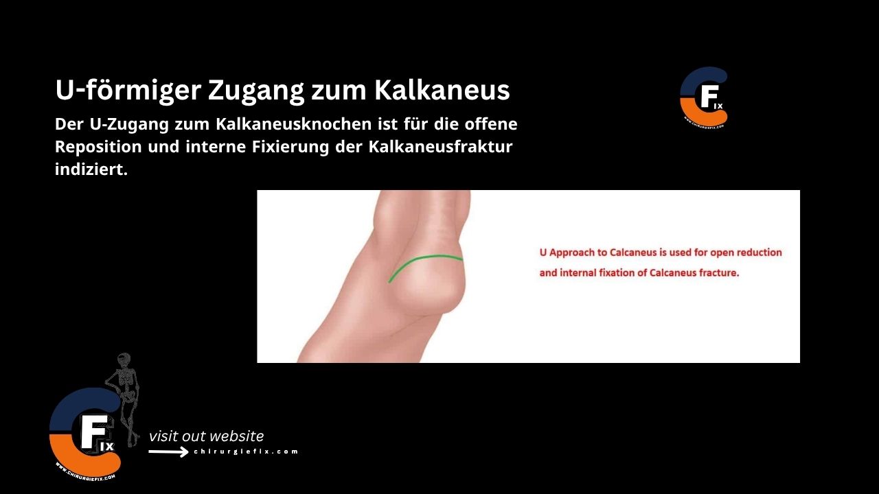 U Approach to Calcaneus