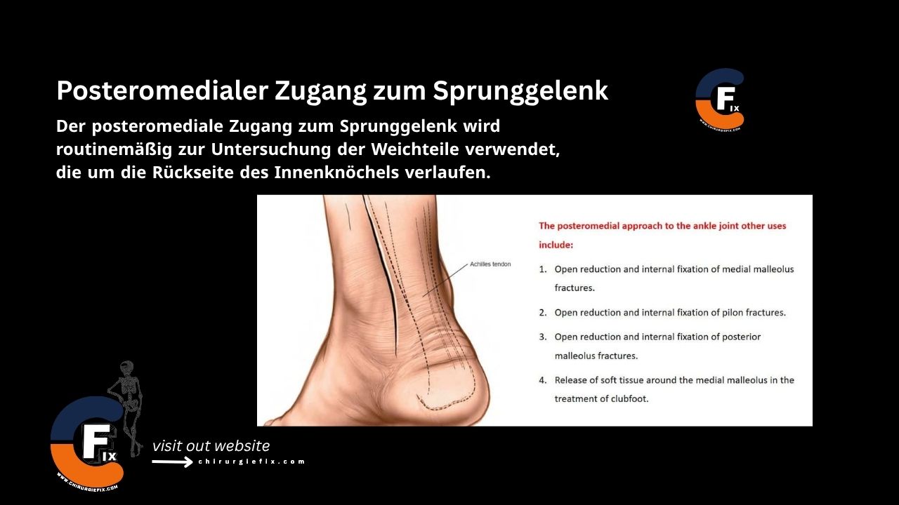 Posteromedial Approach to Ankle