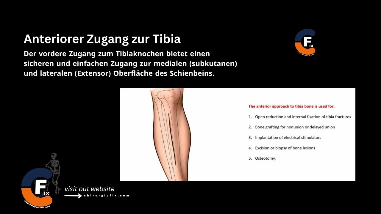 anterior approach to tibia