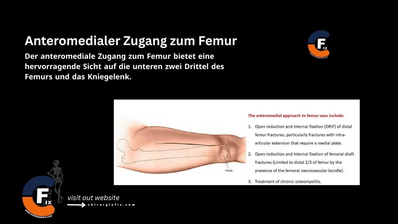 Anteromedial Approach to Femur