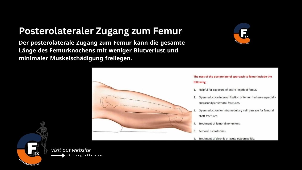posterolateral approach to femur