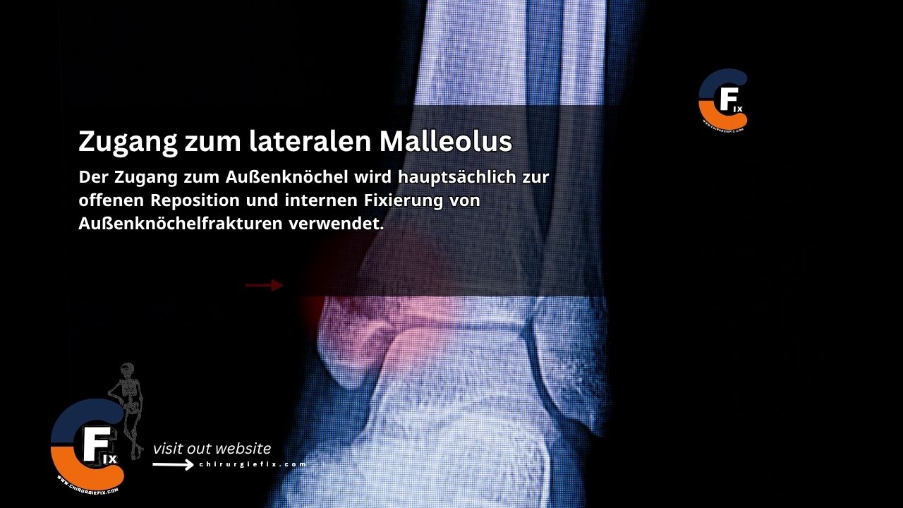 Approach to the Lateral Malleolus