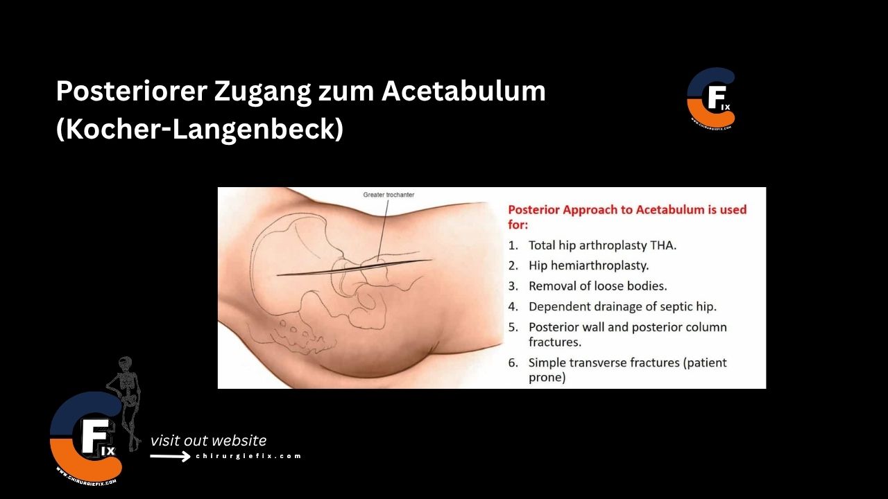 Posterior Approach to Acetabulum
