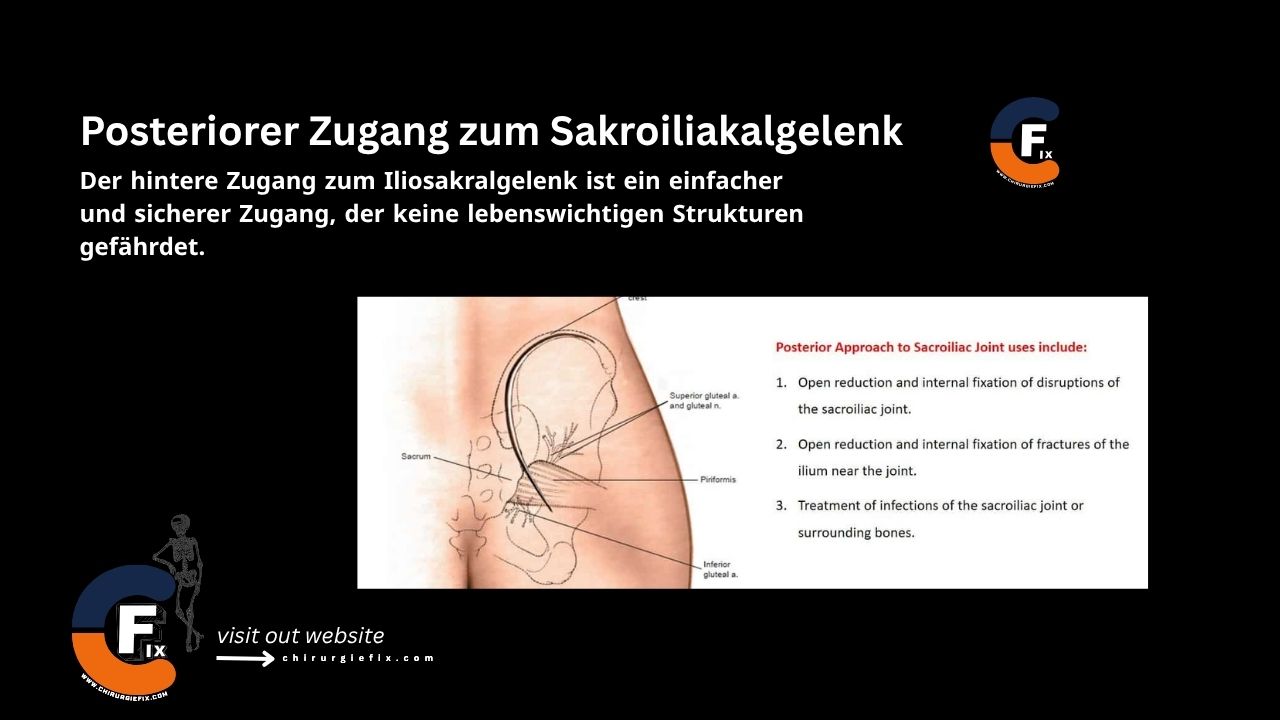 Posterior Approach to Sacroiliac Joint