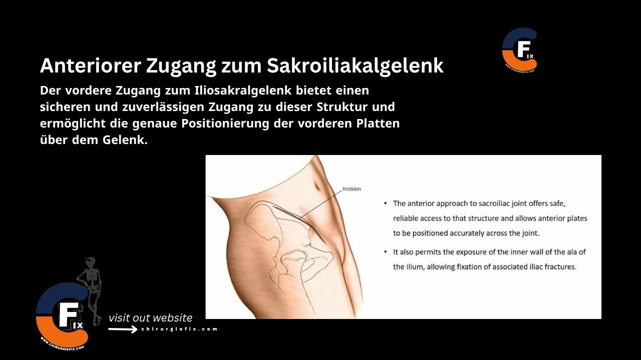 Anterior Approach to Sacroiliac Joint