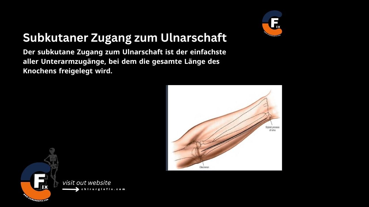 Subcutaneous Approach to Ulnar Shaft