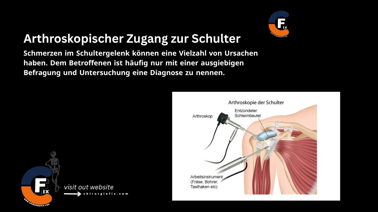 Arthroscopic Approach to the shoulder