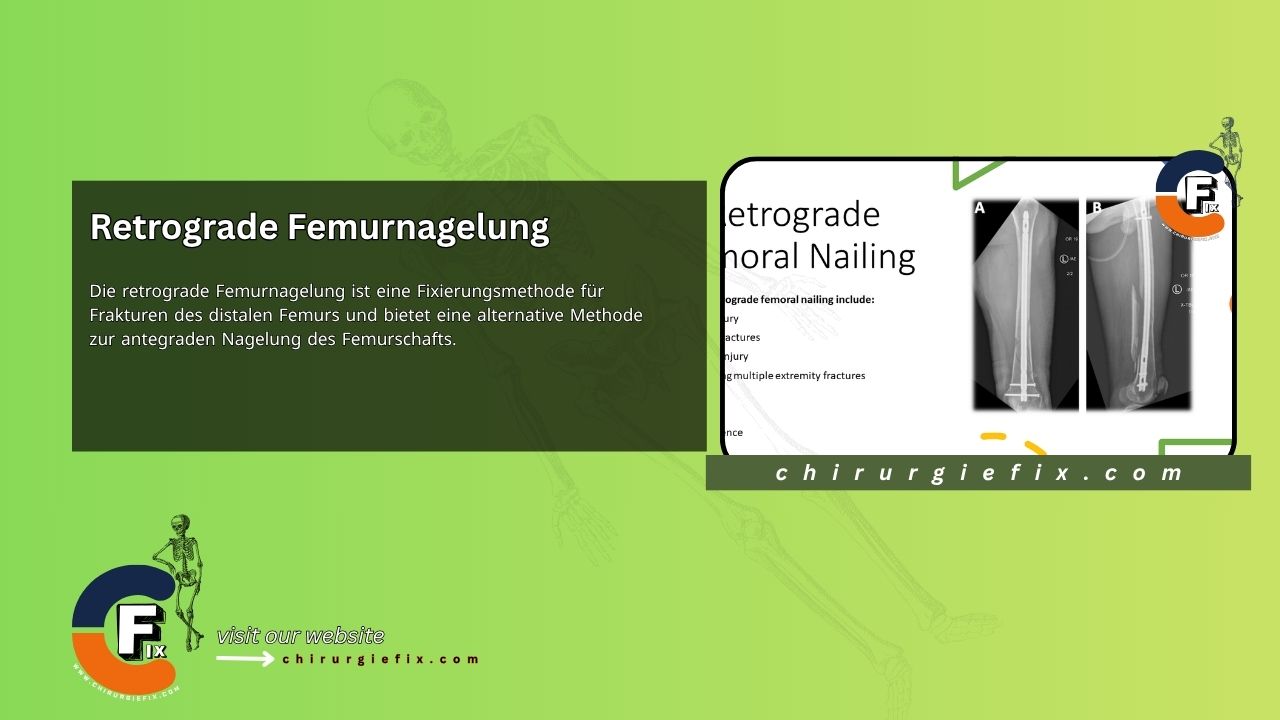 Retrograde Femoral Nailing